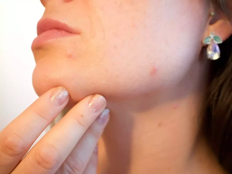 Rephrase the title:Scientists have genetically tweaked the facial acne-causing bacteria to help fight pimples instead!